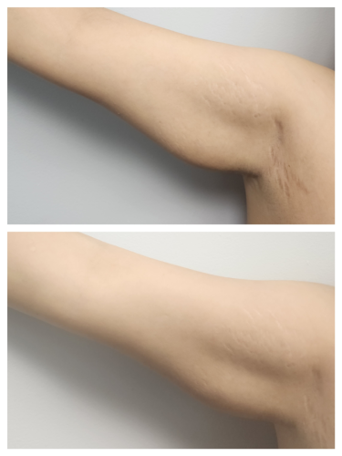 Kybella-PCDC-fat-dissolving