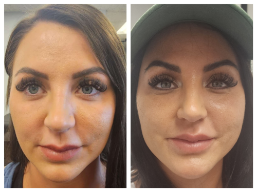 PDO-Threadlift-3-months-later