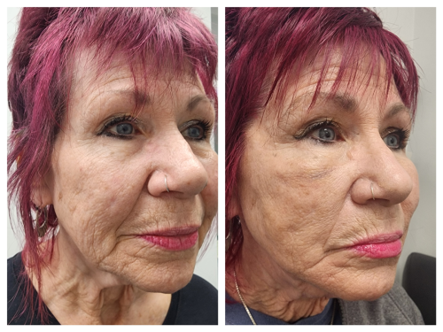 PDO-Threadlift-one-month-later-2
