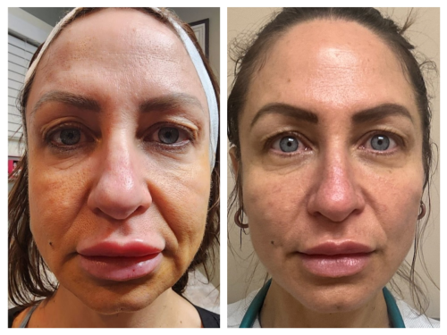 PDO-Threadlift-one-month-later