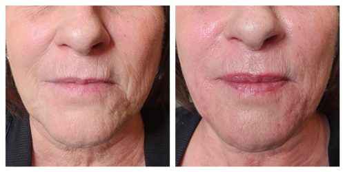 dermal-filler-for-wrinkles-right-after